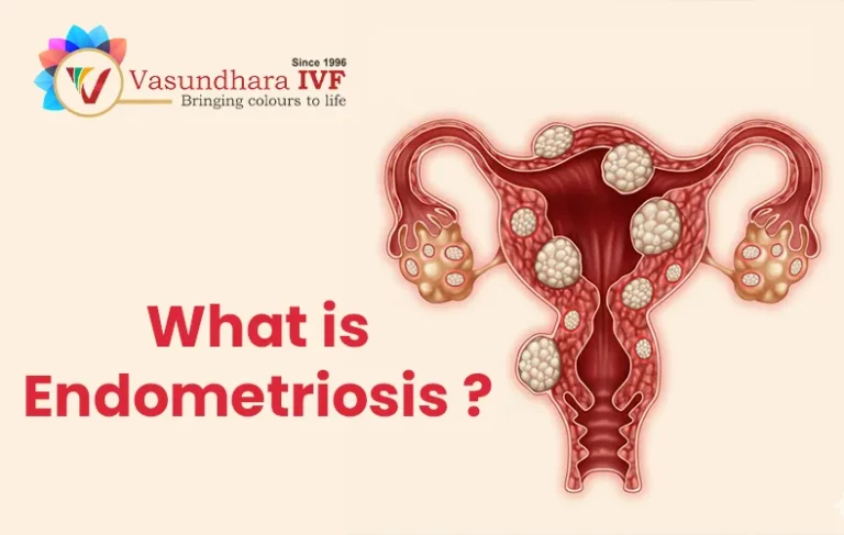 Endometriosis: Symptoms, Causes, Diagnosis & Treatment Options for Better Fertility