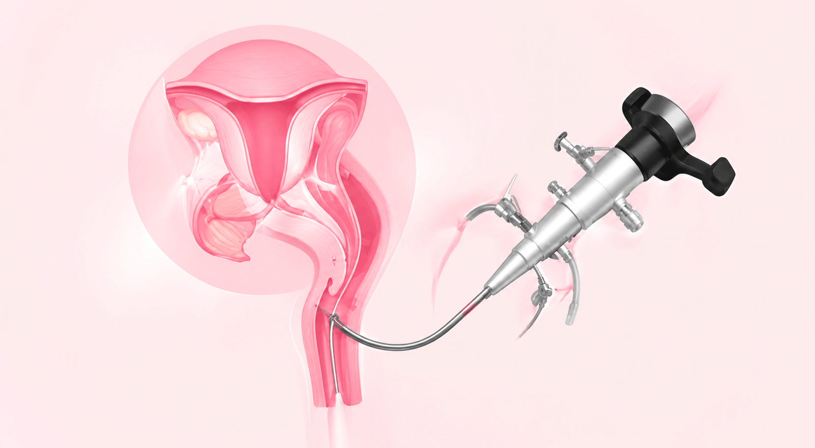 Hysteroscopy