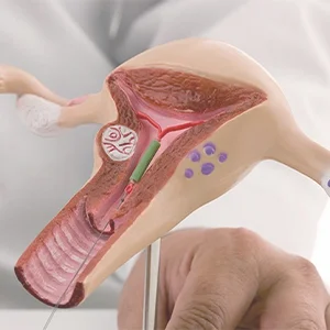 IUI Treatment